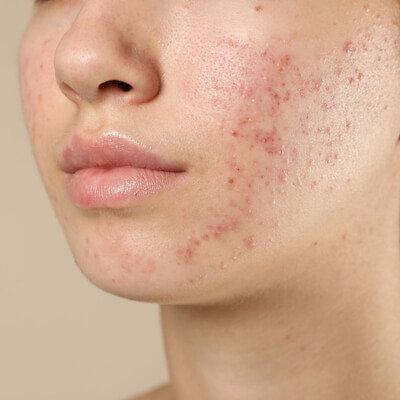 Soin visage pour adolescents à Seraing, traitement des boutons et de l’acné en douceur - Vénus Institut à Seraing